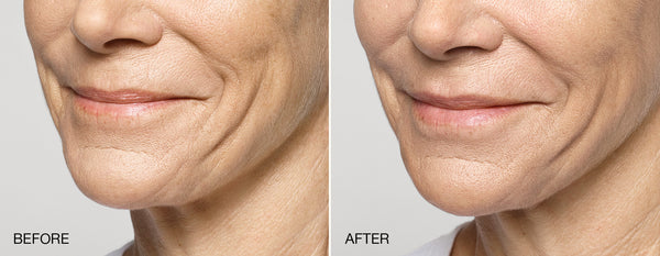 botox Chicago Before and after result