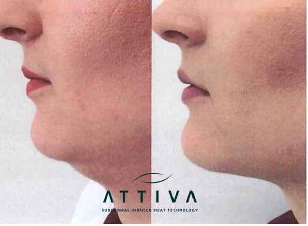 Attiva Skin Tightening Chicago