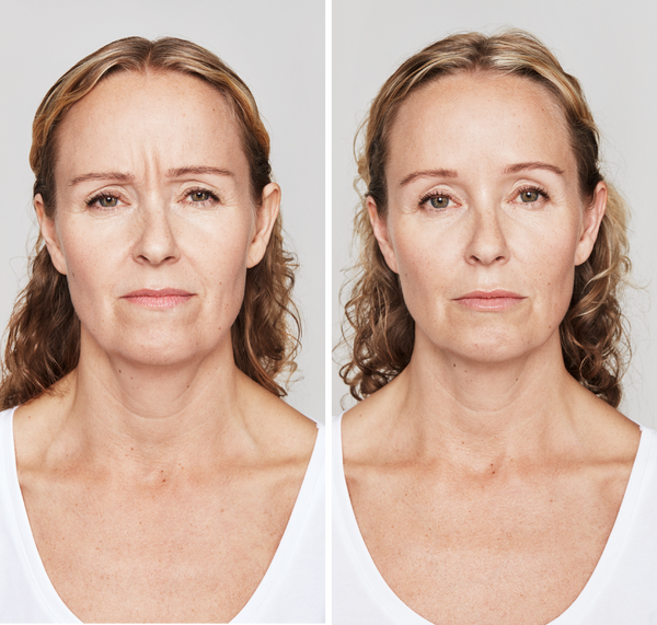 Before and after result Chicago botox