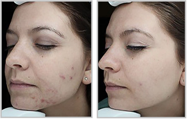 Forever clear before and after Chicago