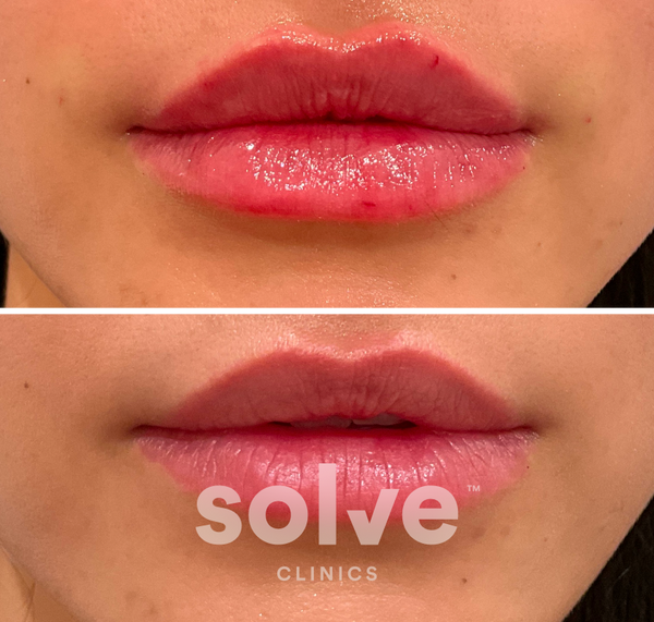 Before and after result