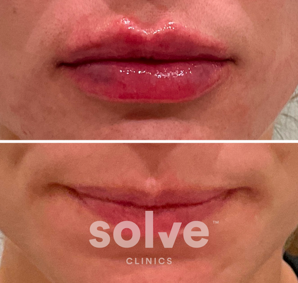 Before and after result