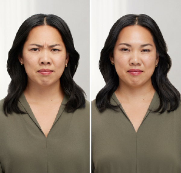 Before and after result botox chicago