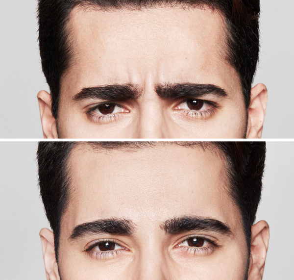 Before and after result from botox in chicago