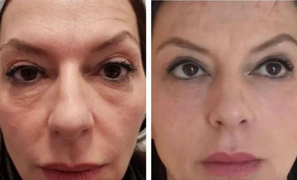 Skin Tightening Before and after result Chicago
