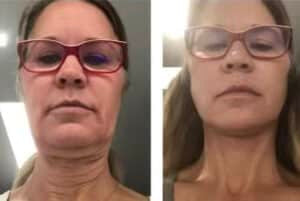 Skin Tightening results Chicago