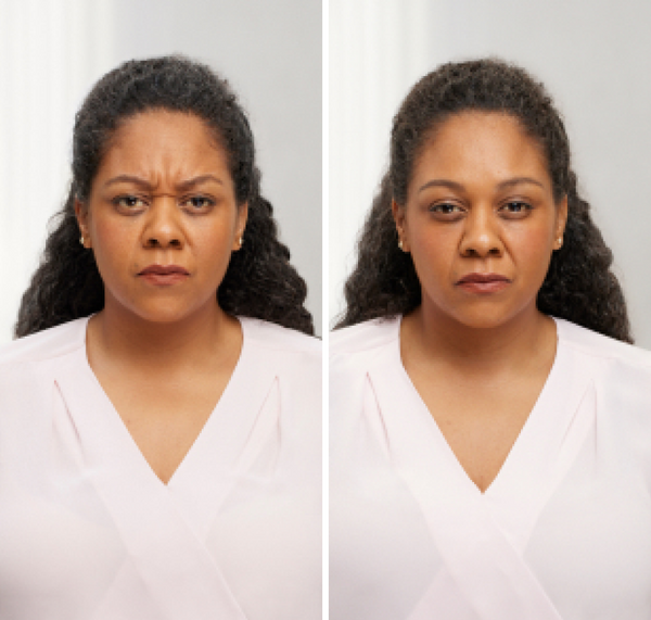 Before and after Botox Chicago