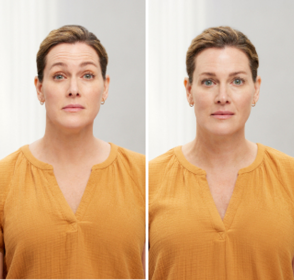 Botox Before and after Chicago