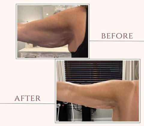 Skin Tightening Before and after Chiago