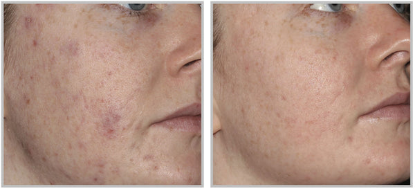 forever clear acne treatment before and after