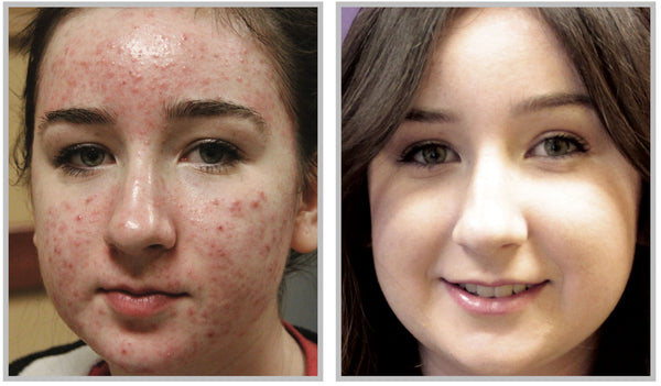 forever clear acne treatment chicago