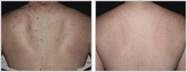 forever clear acne treatment shoulders before and after