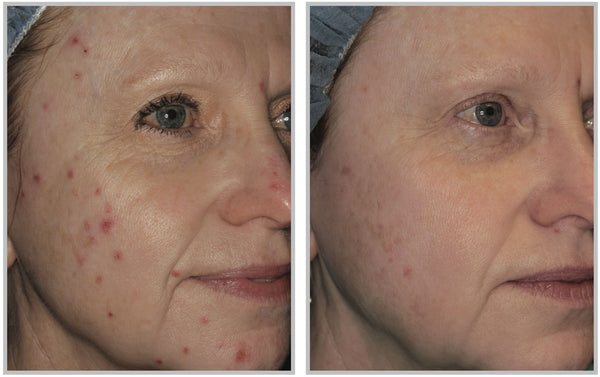 forever clear bbl acne treatment before and after