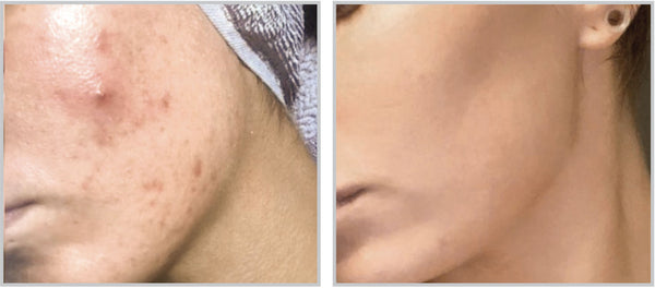 forever clear treatment Before and after result