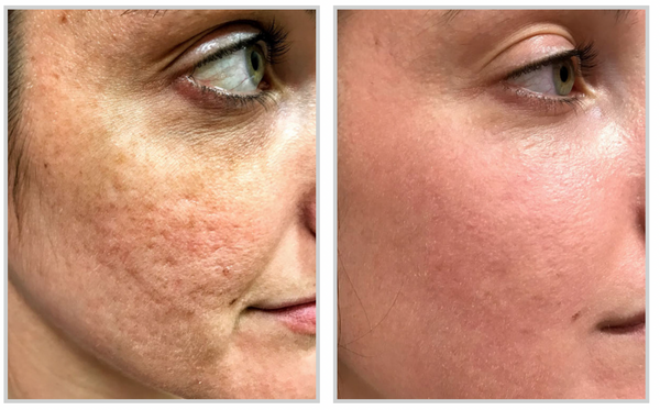 Before and after result