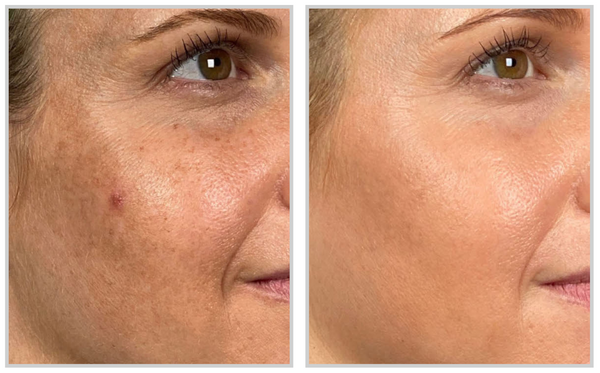 Before and after result