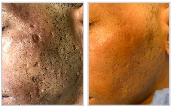 Before and after result