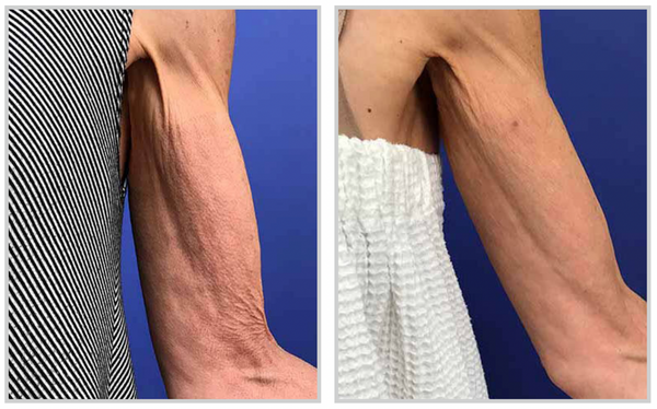 Before and after result