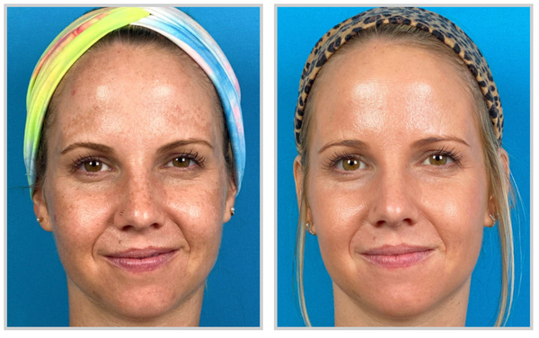 Before and after result