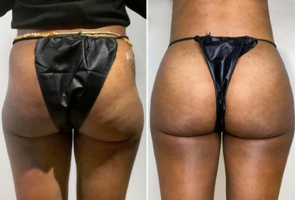 Before and after result