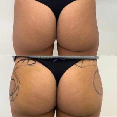 Before and after result