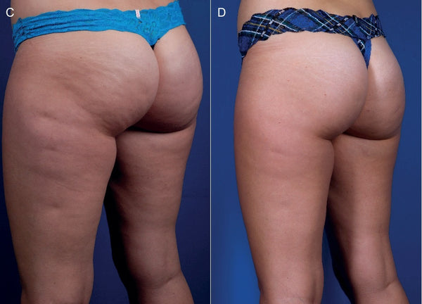 Before and after result