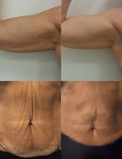 Skin Tightening Chicago